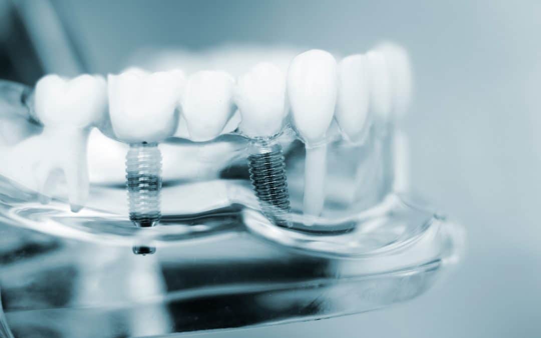 Dental implant model at Glen Forest Dental CO in Richmond VA