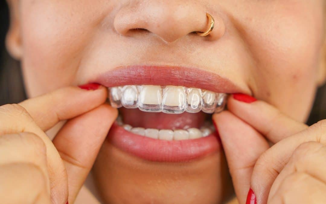 Woman placing her invisalign in her mouth in Richmond VA
