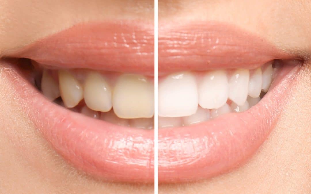 Before and after of professional teeth whitening in Richmond VA